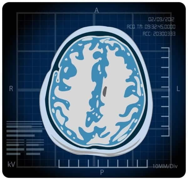 Brain MRI